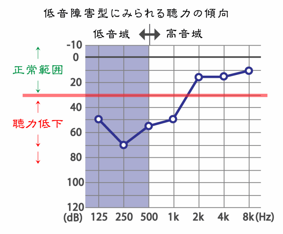 豊田市低音難聴の治療