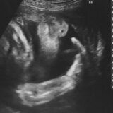 ためしてガッテン逆子治療特集