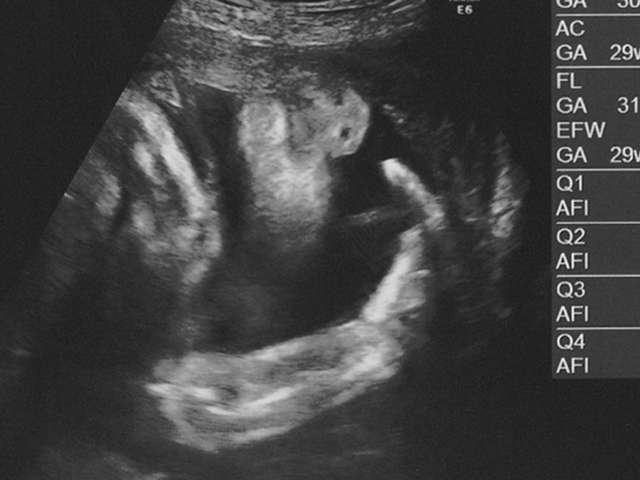 ためしてガッテン逆子治療特集