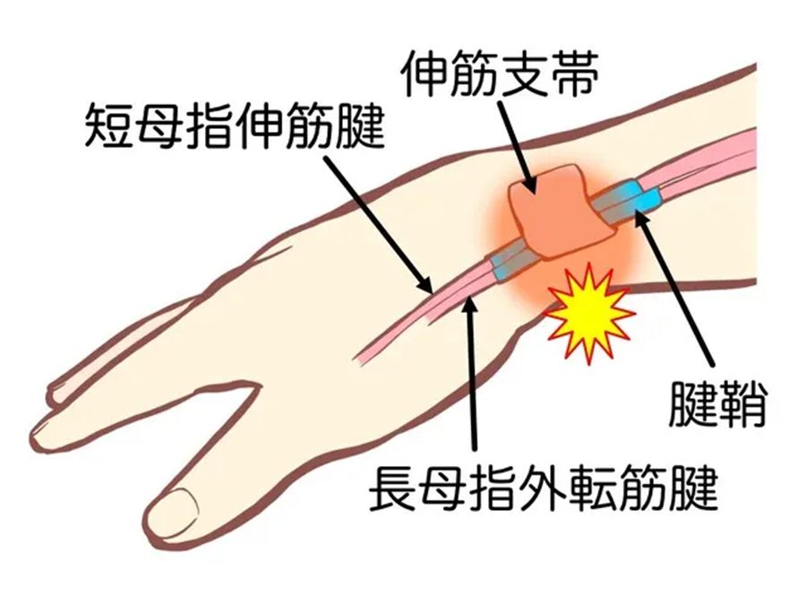 豊田市腱鞘炎治療