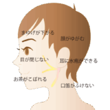 豊田市顔面神明麻痺の専門治療