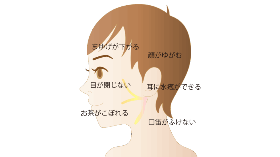 豊田市顔面神明麻痺の専門治療