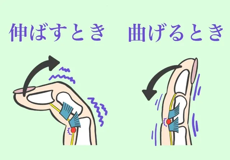 豊田市ばね指治療