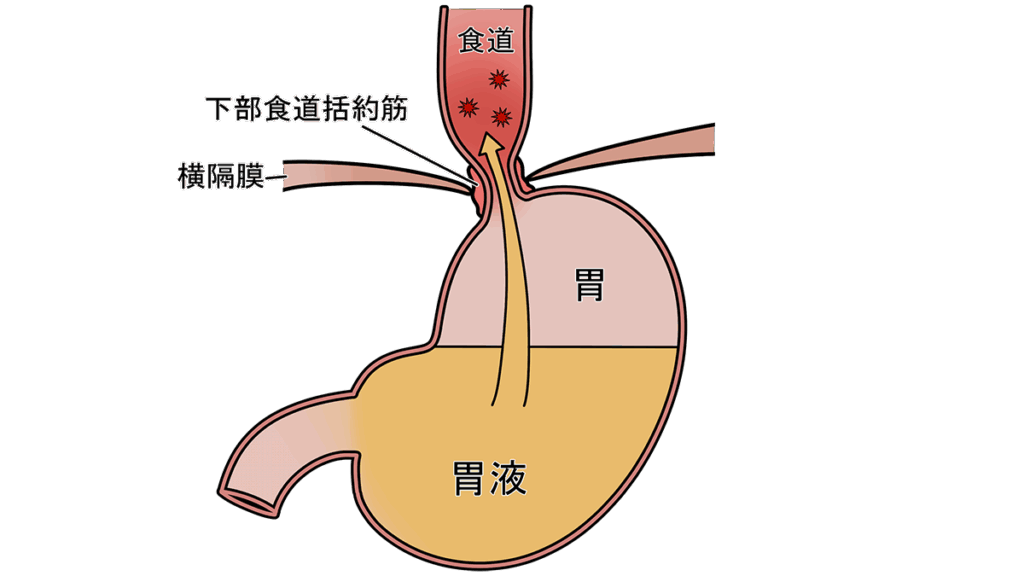 逆流性食道炎の治療