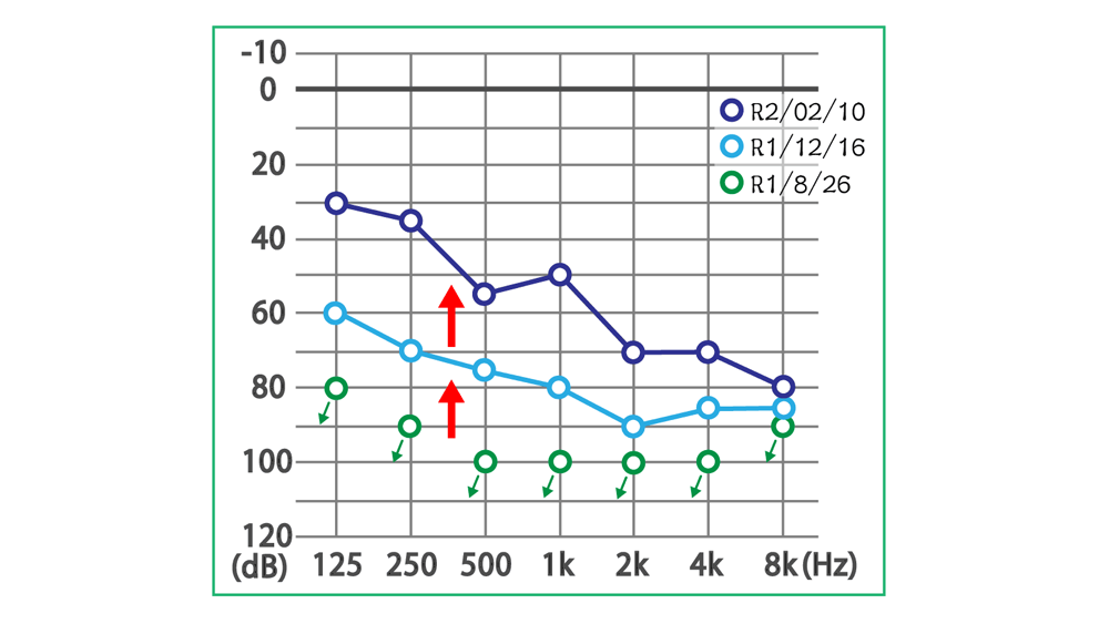 豊田市ムンプス難聴の治療