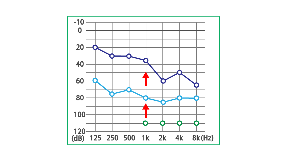 豊田市ムンプス難聴外来