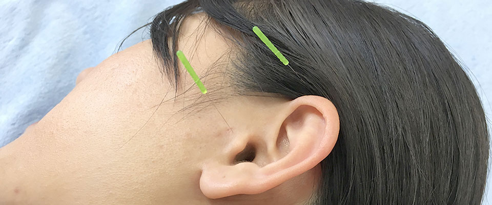 突発性難聴に対する鍼灸治療